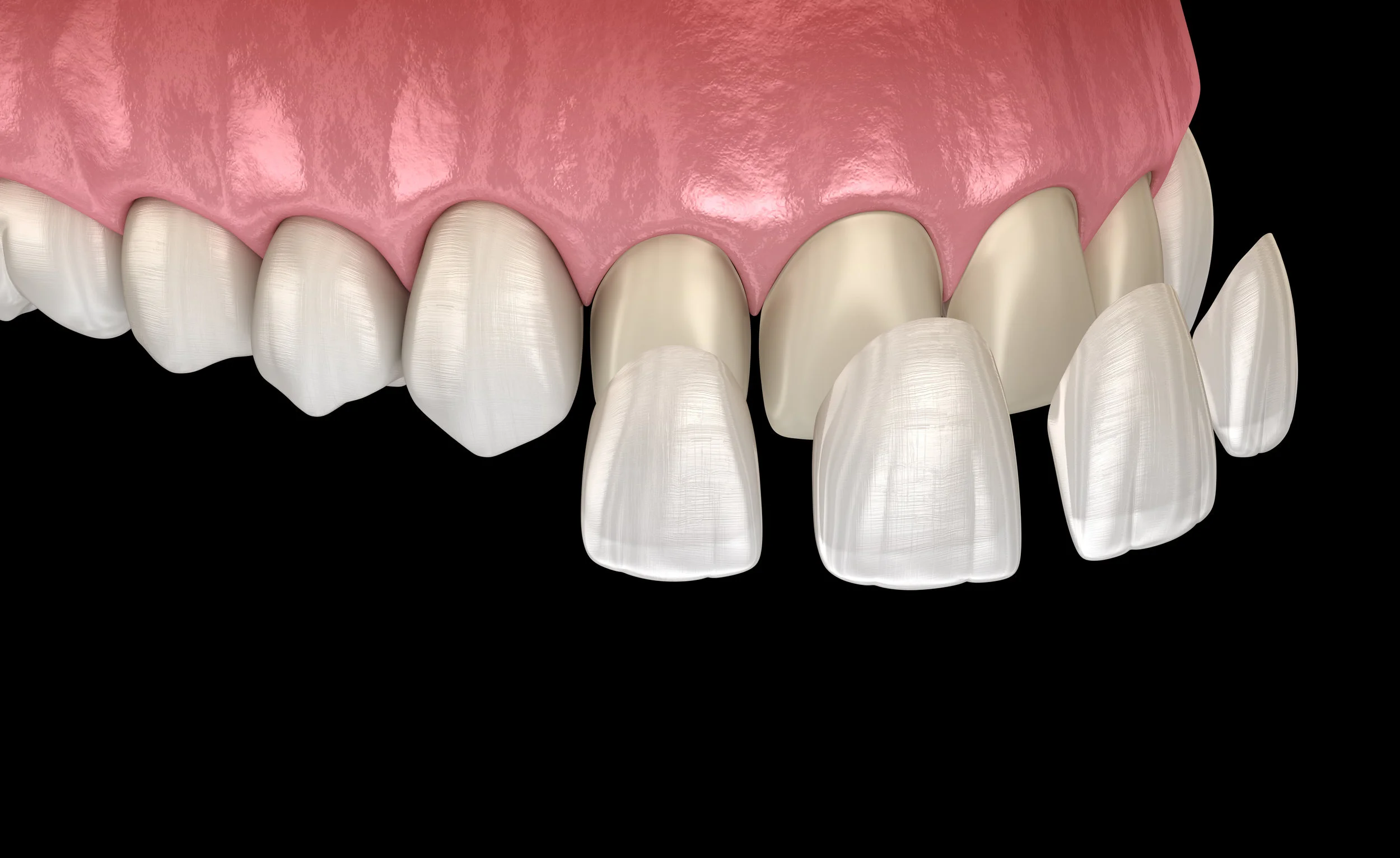 VENEERS .jpg