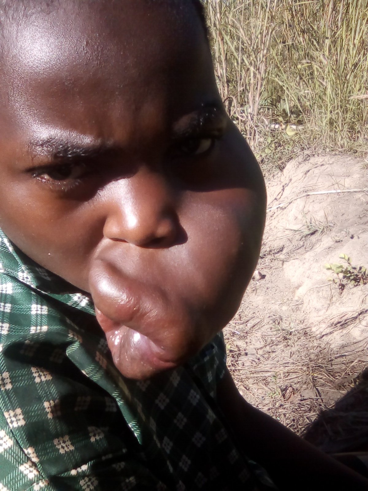 Mphatso's facial tumor has been growing since birth.