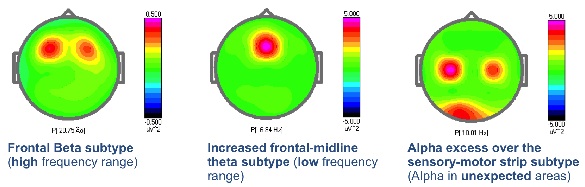 Example of three different ways that ADHD can manifest in the brain. Each pattern can be more effectively treated with neurofeedback protocols that are targeted to train the affected areas.