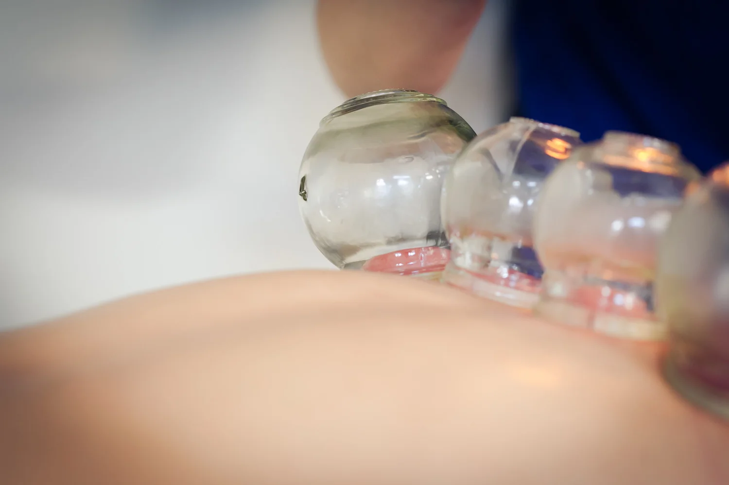 CUPPING