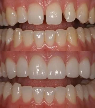 veneers.jpg