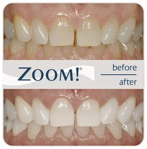 A Whiter Smile Without  the High Cost!