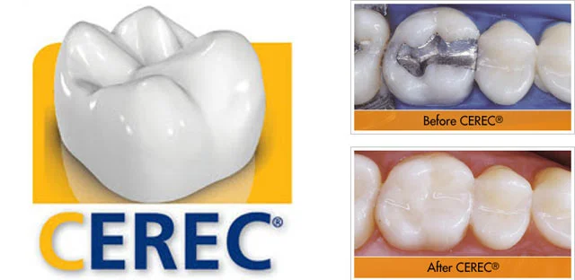 Crowns Without the Discomfort, Wasted Time, or Other Common Issues 