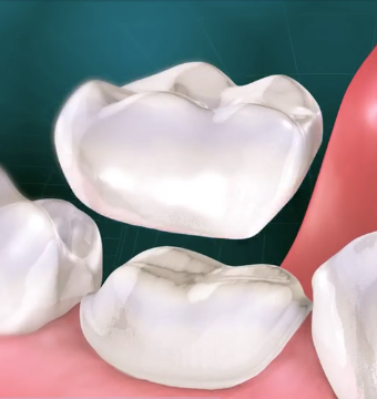 Crown being placed on a prepped tooth