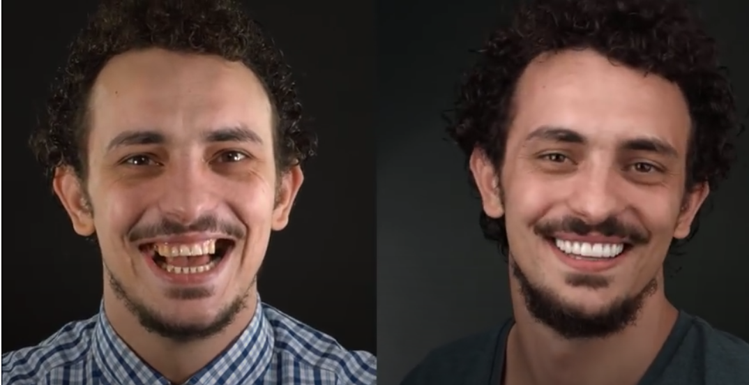 Improving Your Smile with Veneers