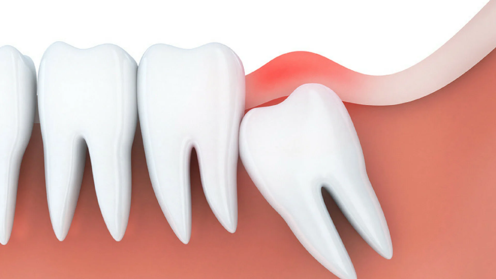 Is wisdom teeth removal necessary?