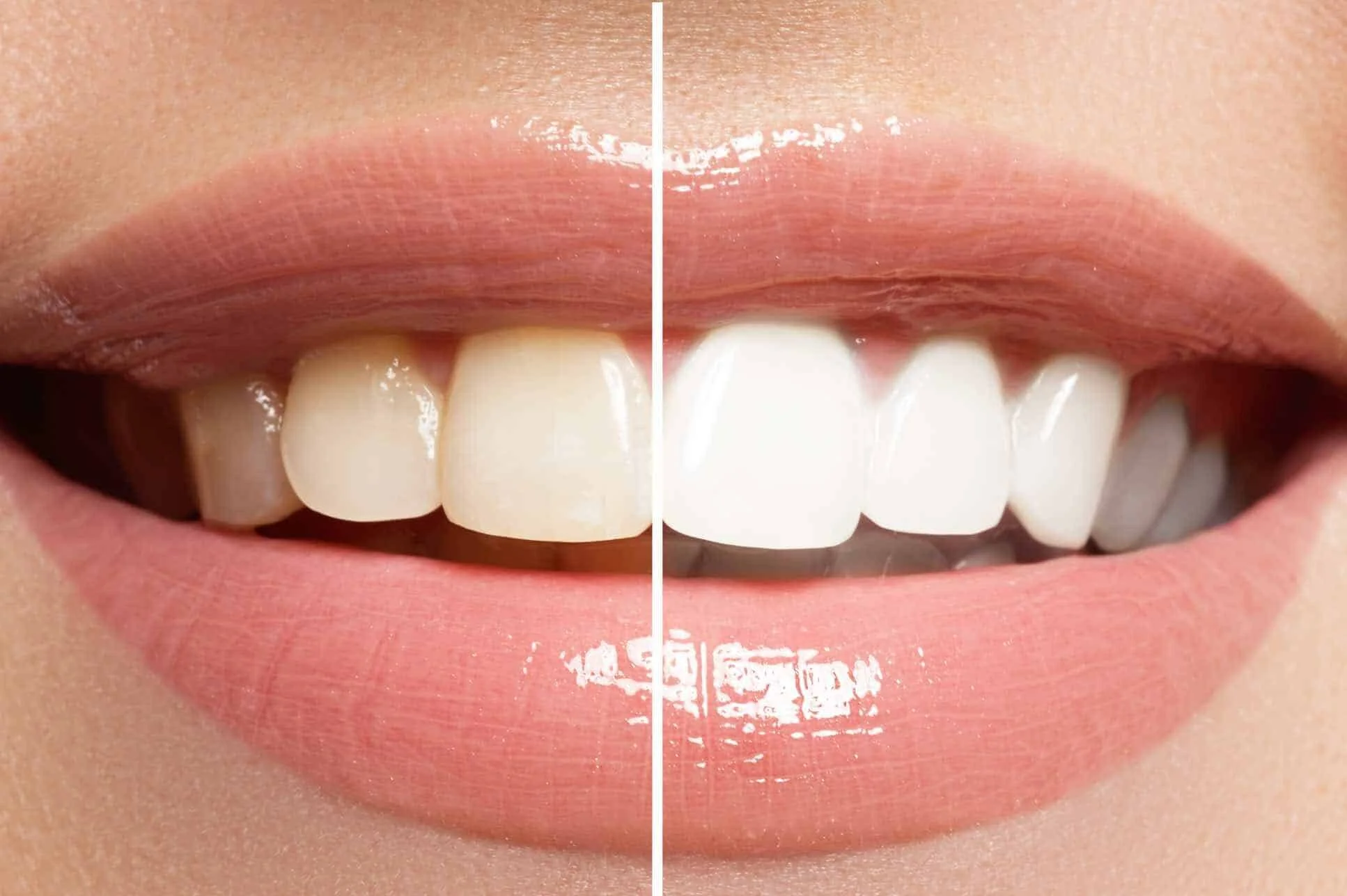 Let's talk about Teeth Whitening
