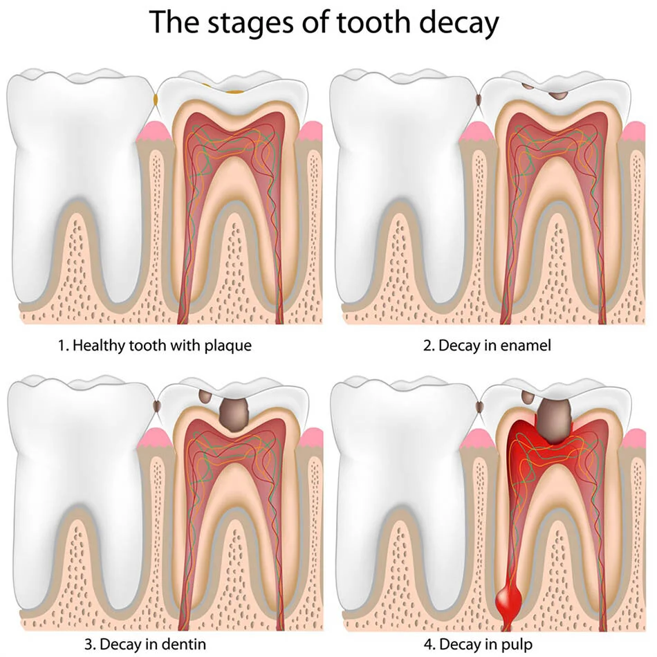 What is tooth decay?