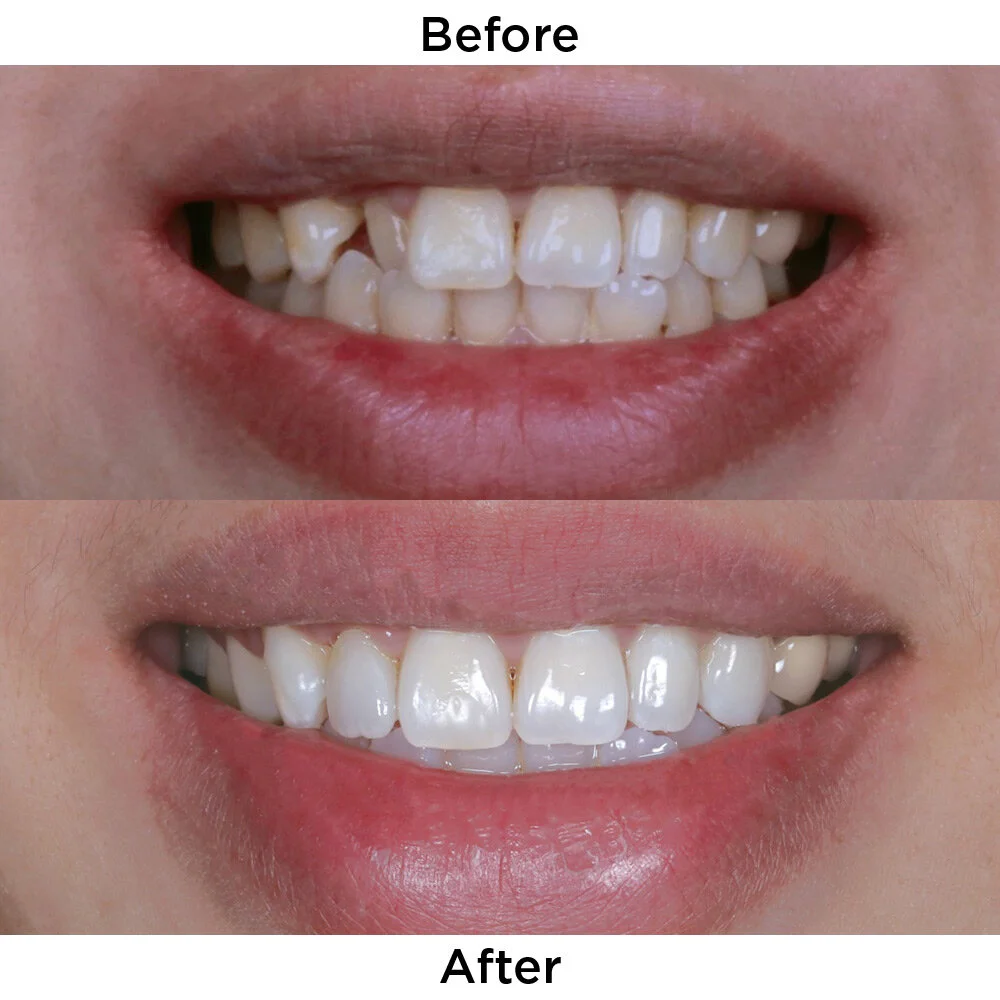 Smile Design