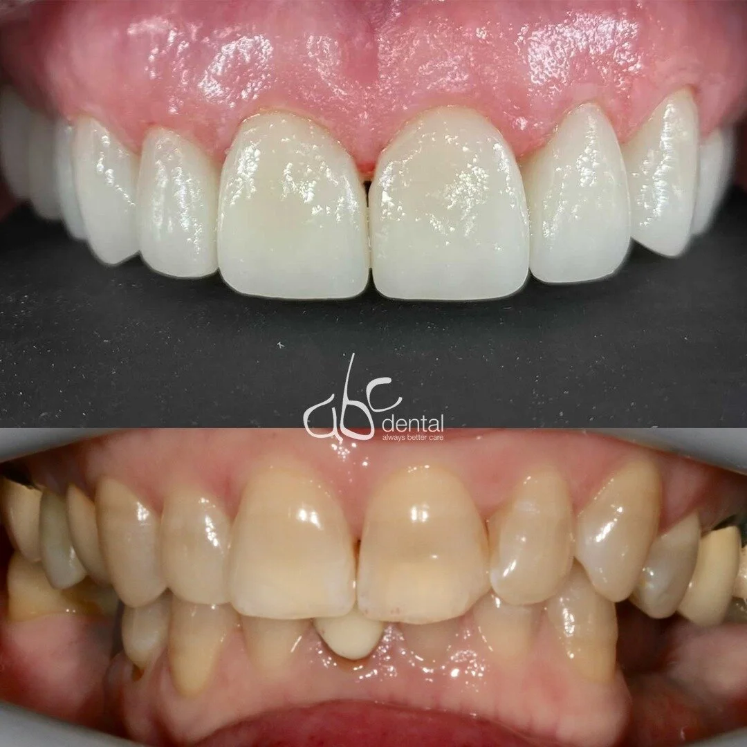 Cosmetic Smile Design, Lumineers, NoPrep Veneers to improve your most