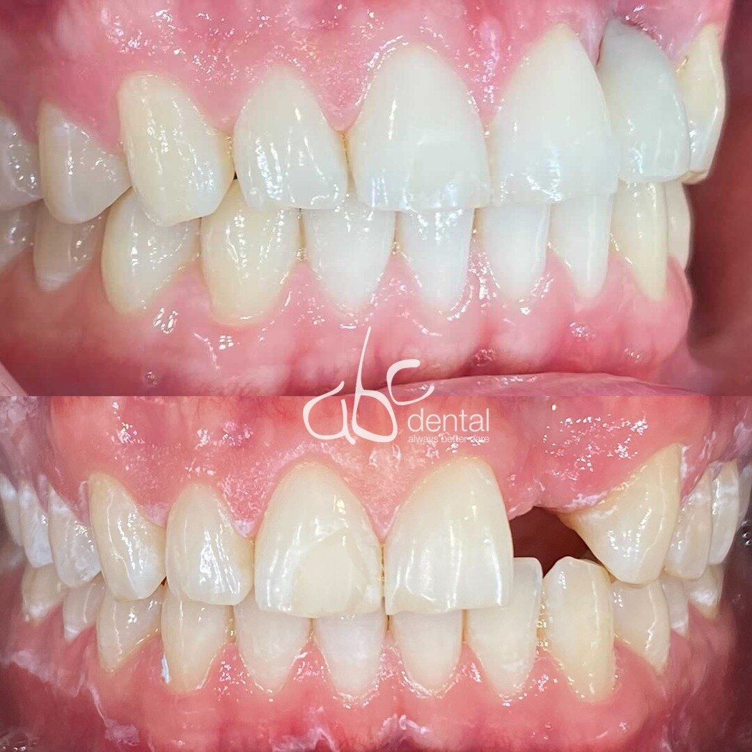 Case 50

#implant , #sydney , #cosmeticdentistry
