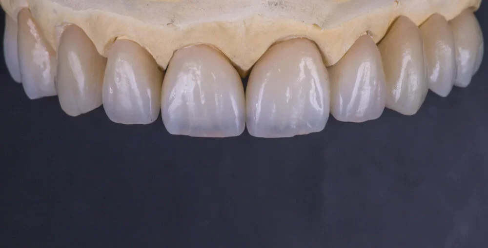 Enamadent-Main-veneers.webp