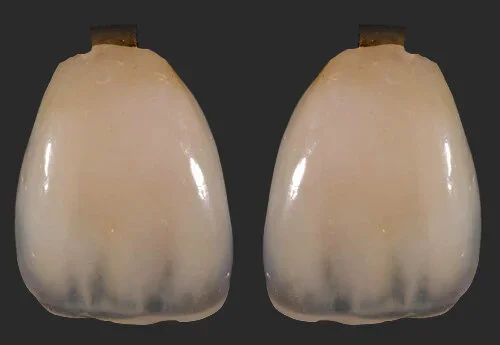 veneers (1)-abc-dental.webp