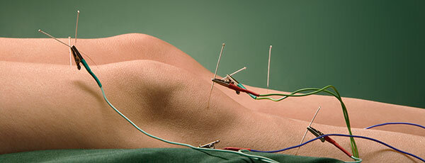 Electrical Stimulation, E-Stim