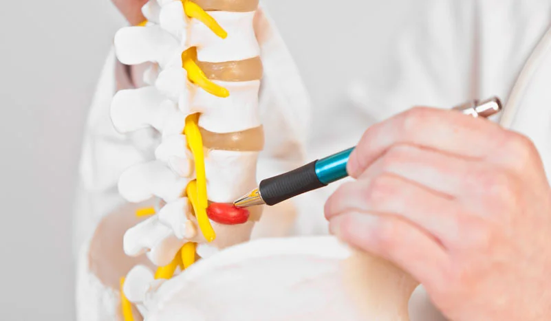 Hernia discal, lo que debes conocer