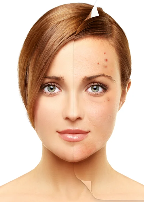 Acne Scars treatment