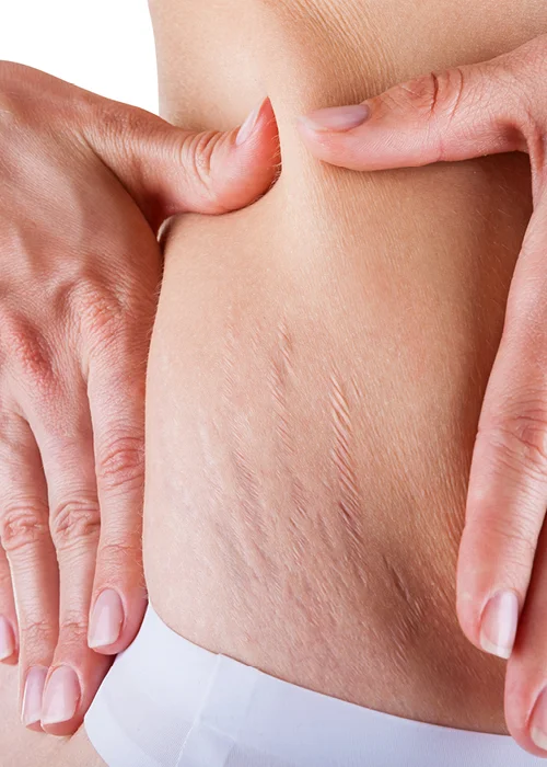 Stretch Mark solutions and treatments