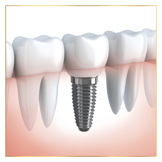 IMPLANTS
