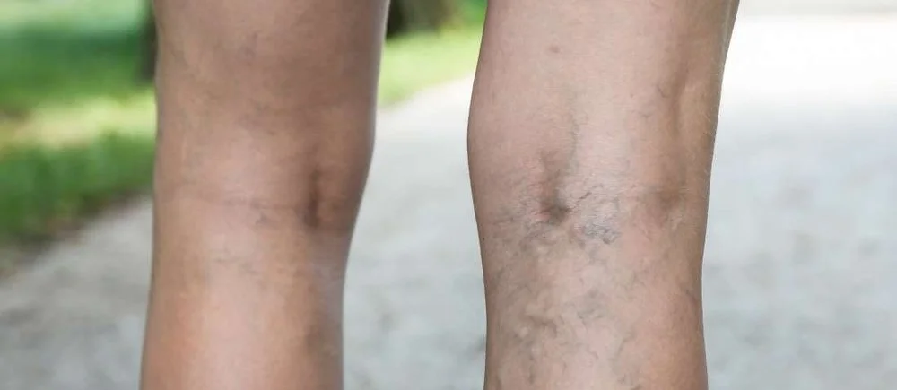 How to Treat Varicose Veins