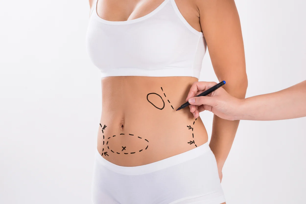 What is liposuction?