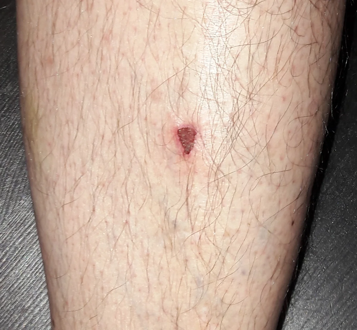 Triangular-leg-scar.jpg