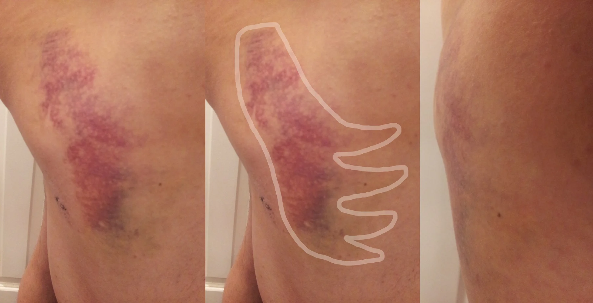 bruises-together-with-line-2.jpg