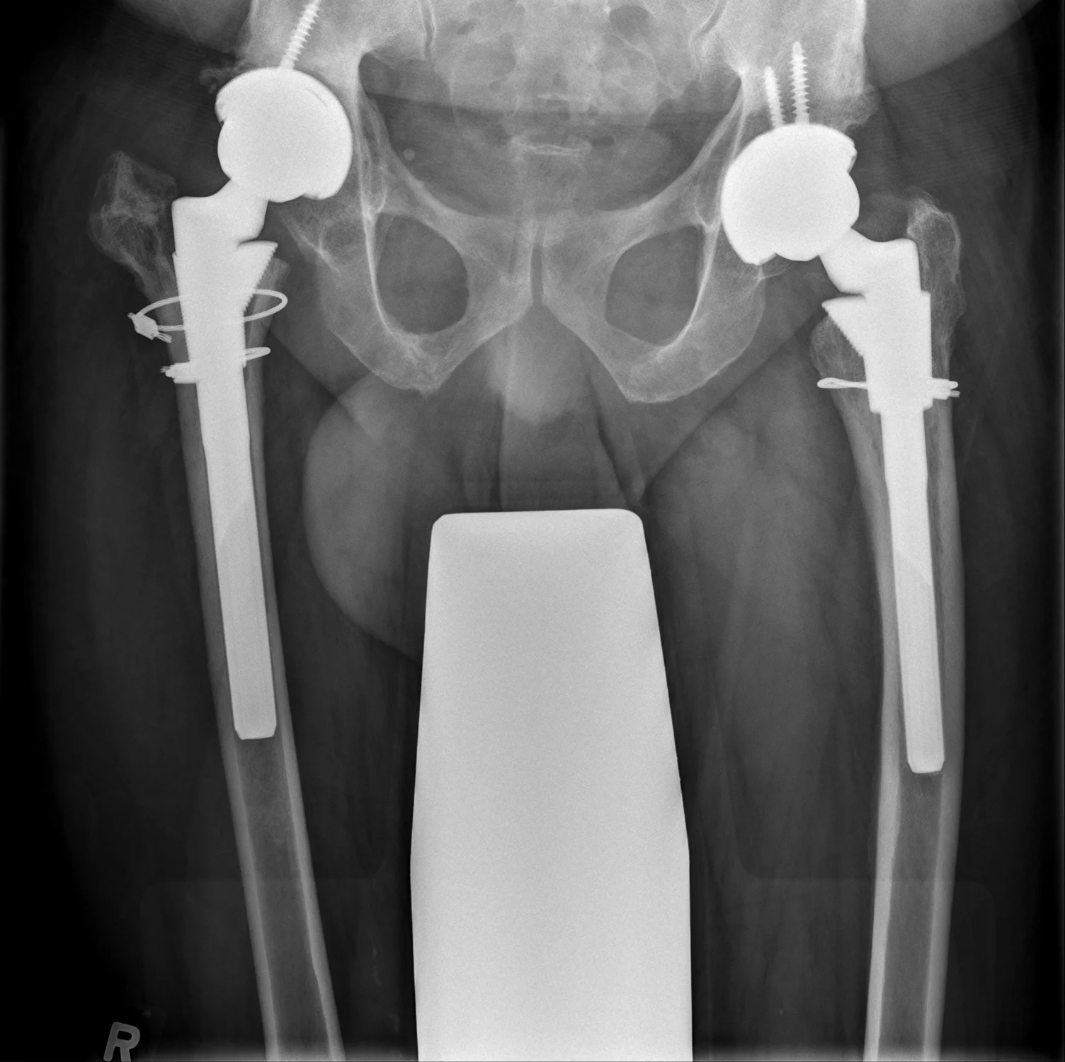 This shows satisfactory positioning of the implants. The patient has made a good recovery and is much more mobile and pain-free as a result.