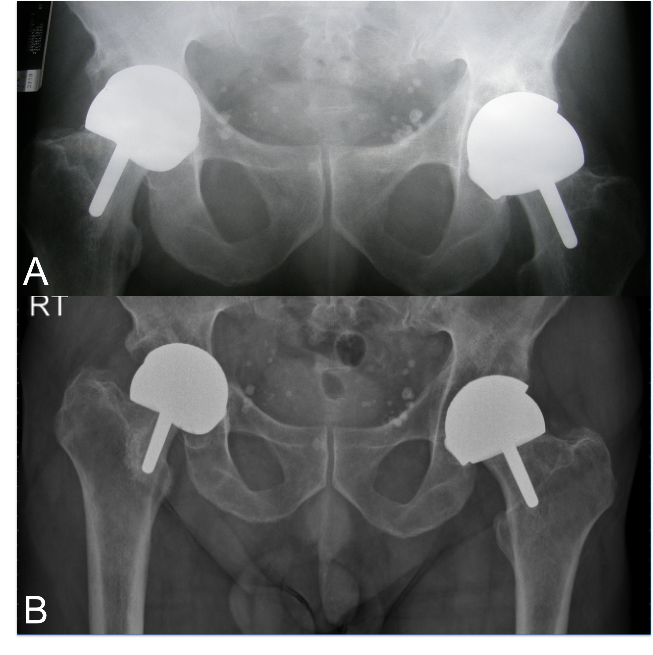 METAL DEBRIS DISEASE CASE TWO Osteolysis Secondary To Metalosis