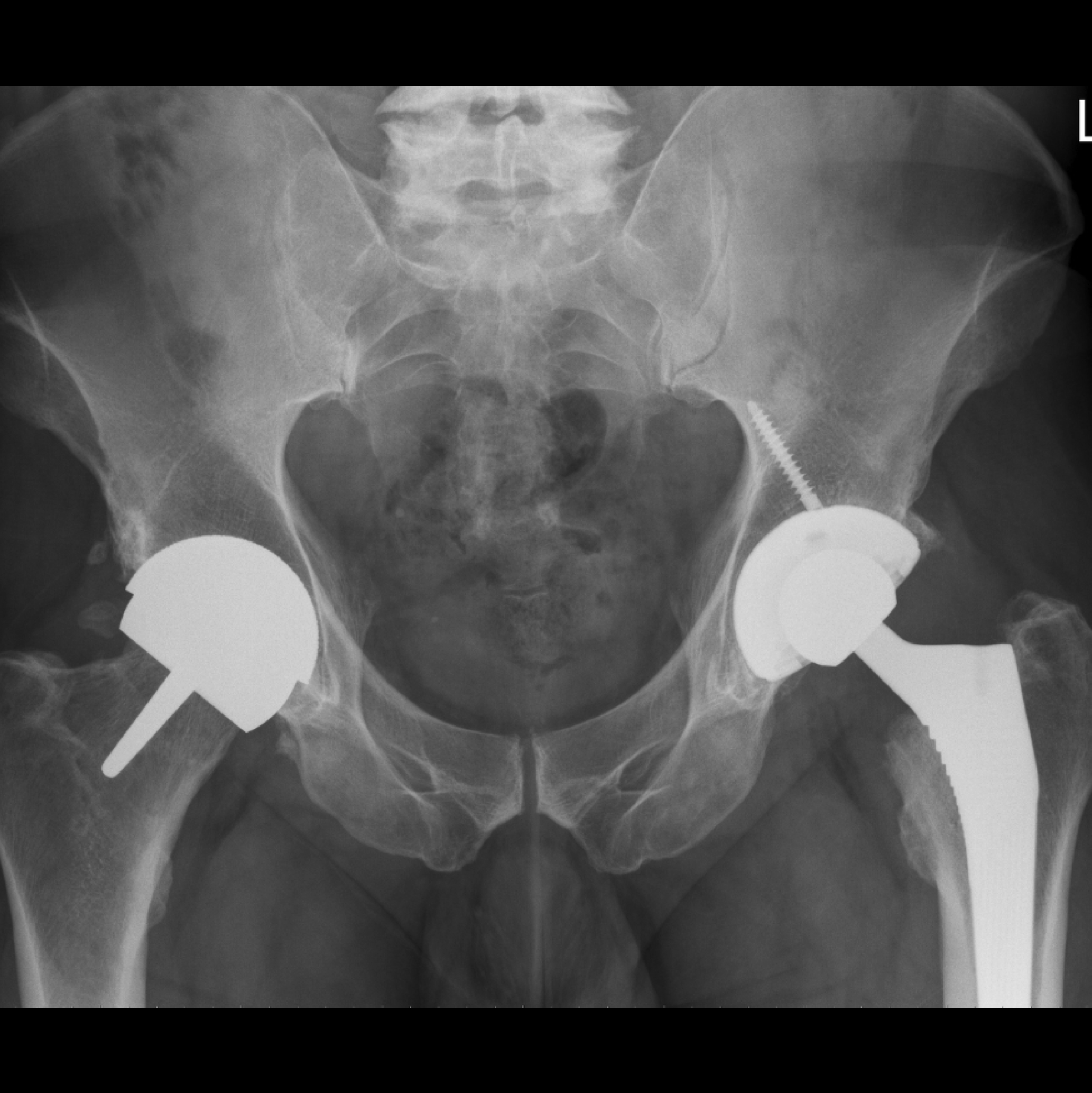 The radiograph shows a satisfactory outcome following the left hip revision operation.