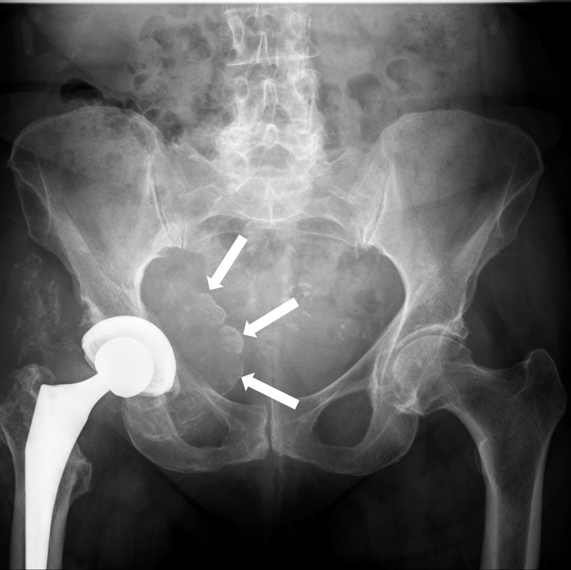 The pre-op radiograph doesn't reveal anything significant.