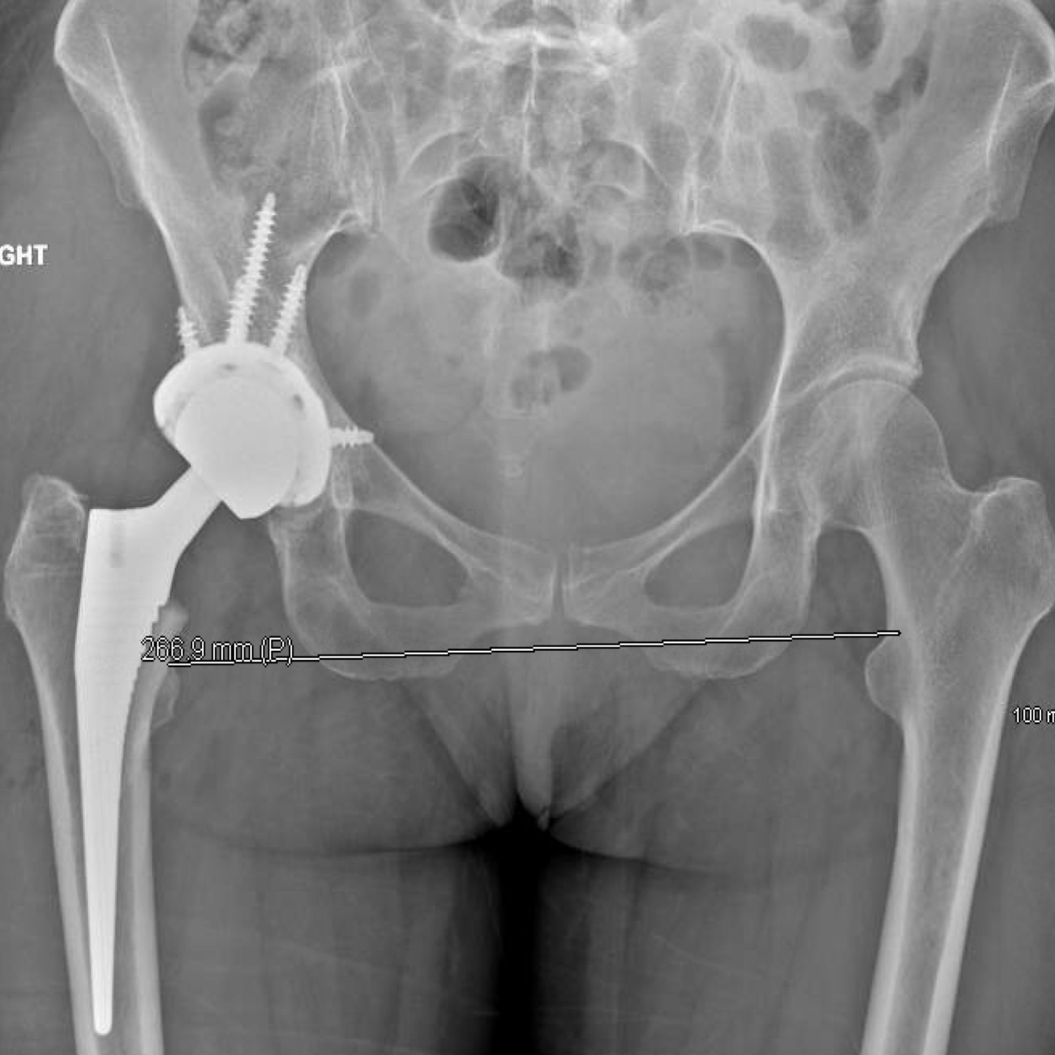 The radiograph shows a satisfactory outcome following the left hip revision operation.