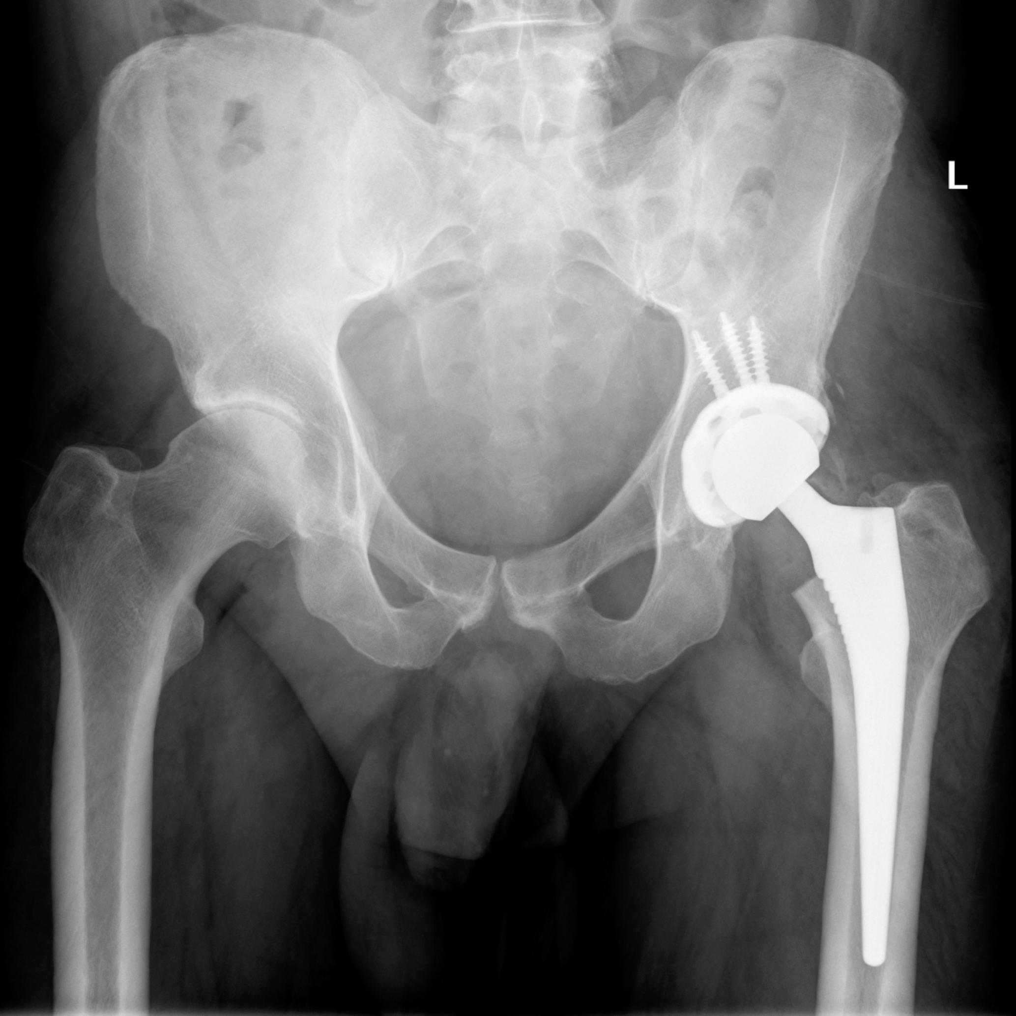 The radiograph shows a satisfactory outcome following the left hip revision operation.