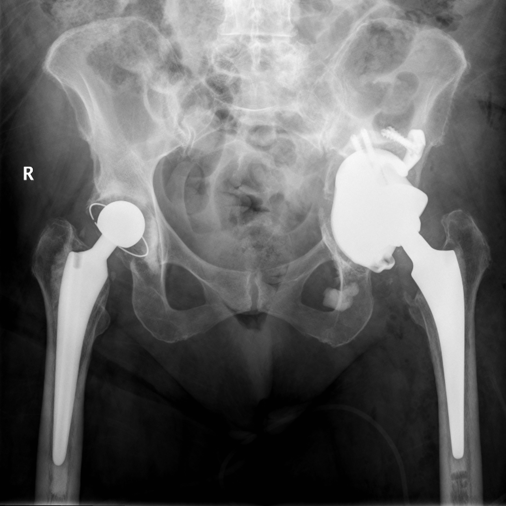 Post operatively he has a stable hip and is pain free. His Oxford Hip Score is 34/48 (score lowered by a pre-existing foot deformity).
