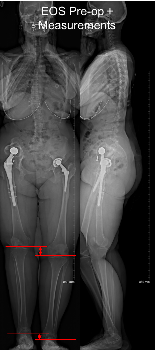 Pre-op EOS with lines.png