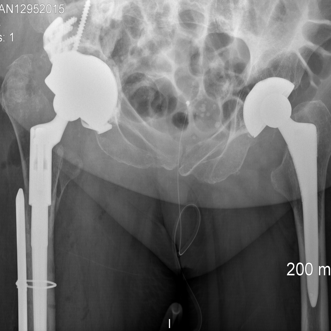 Post operatively he has a stable hip and is pain free. His Oxford Hip Score is 34/48 (score lowered by a pre-existing foot deformity).