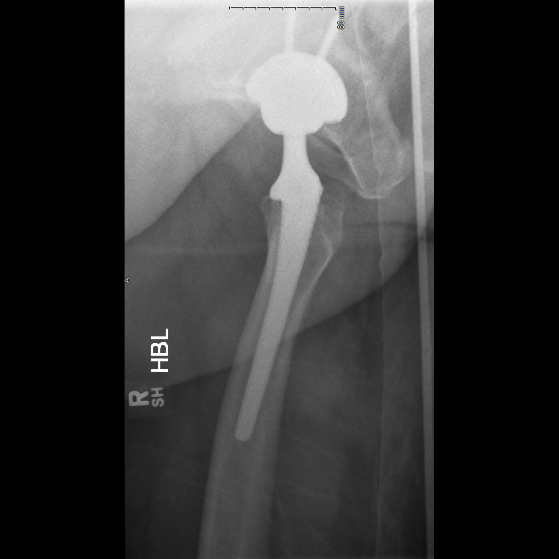 Post-op ceramic fracture replacement lateral case 2.png