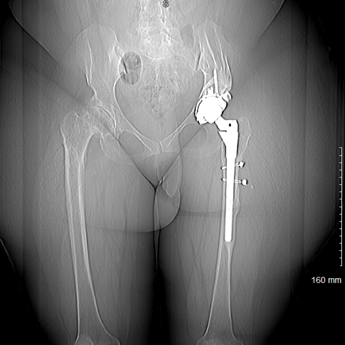 Post-op square scannogram.png