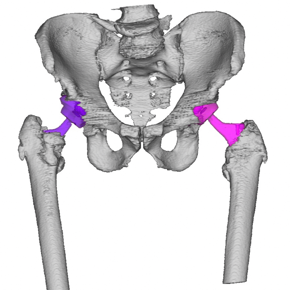 Lexi Reconstruction Pre-op Square.png