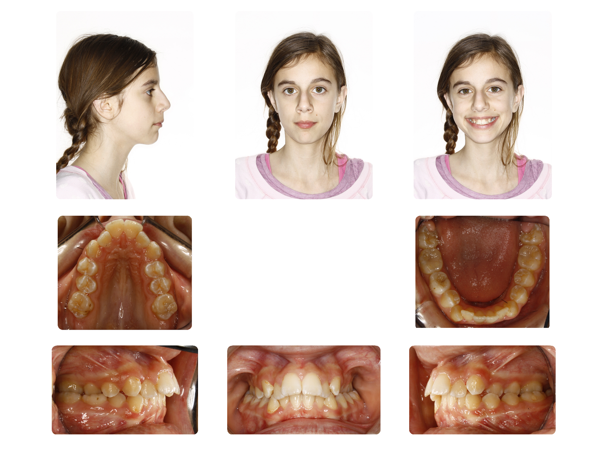 Before Narrow upper arch with teeth in cross bite; Patient V.C started 12 Yrs. Old