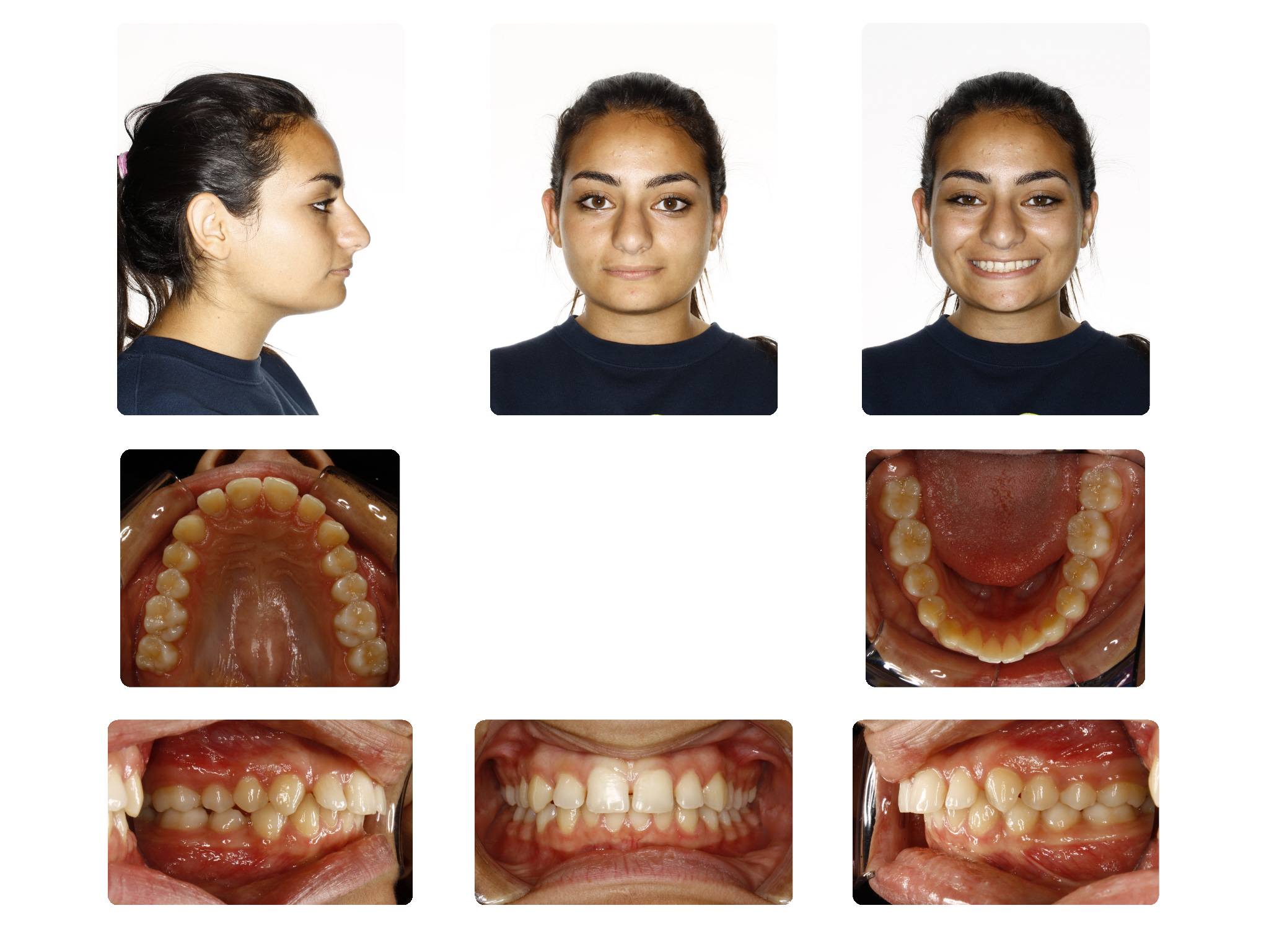 Before Deep bite case; Patient R.M started 16Yrs. Old