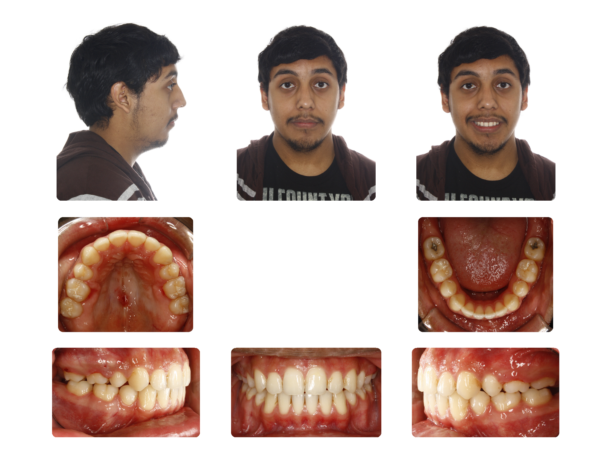  After J.S finished treatment 17Yrs. Old