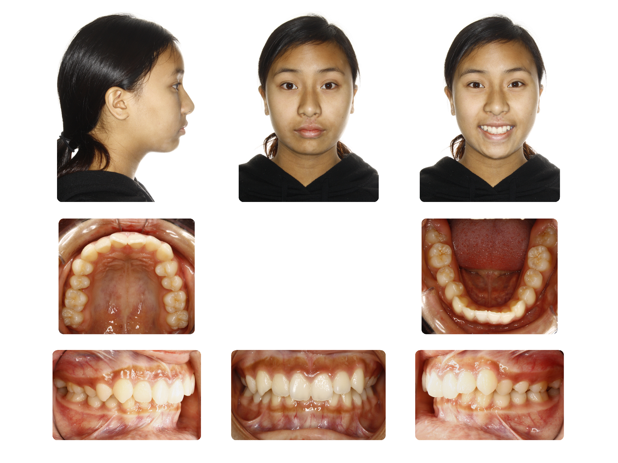 Before Large over Jet, class II malocclusion case; Patient D.L started 14 Yrs. Old
