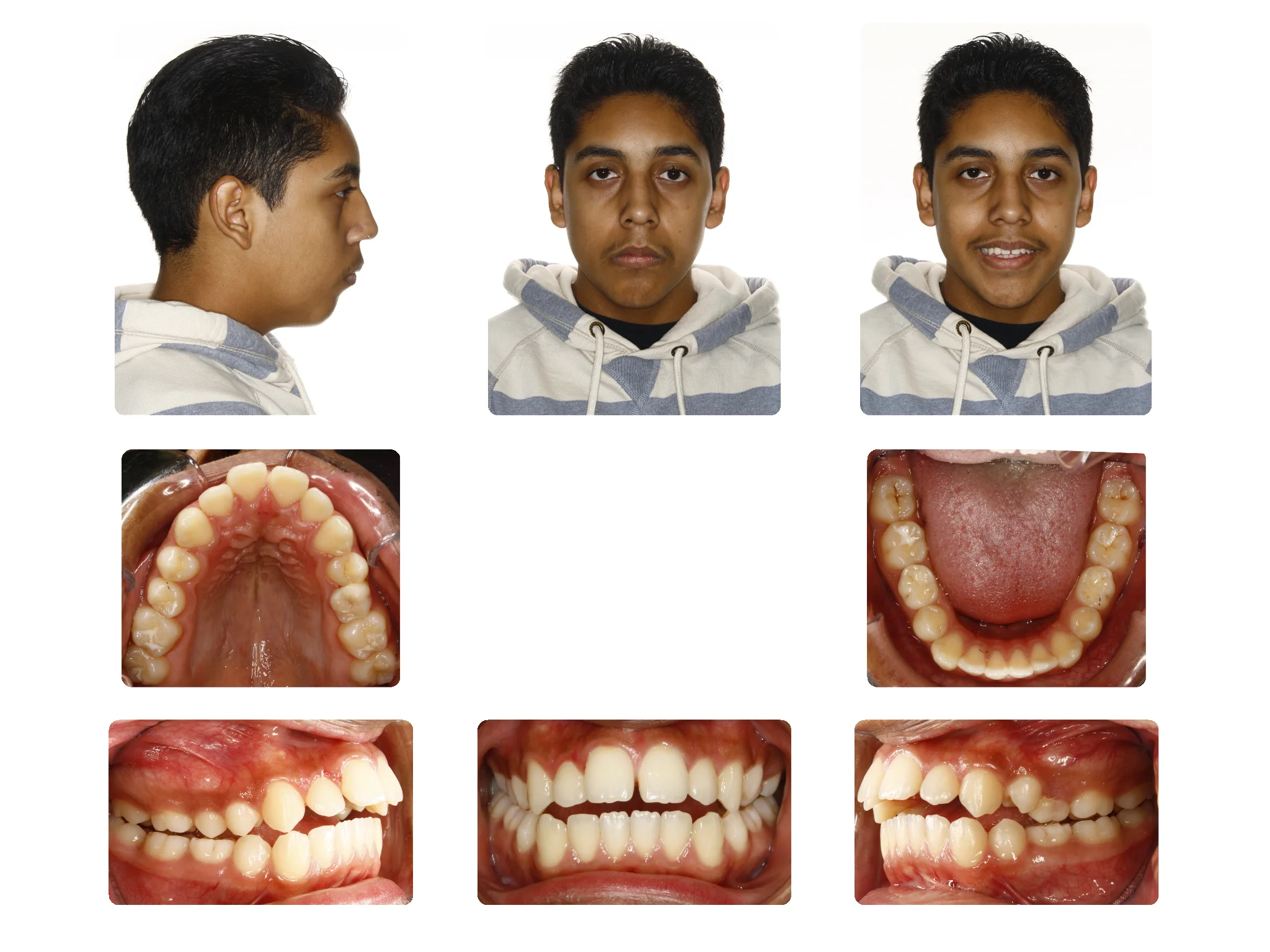 Before Open Bite case; Patient J.S started 15Yrs. Old