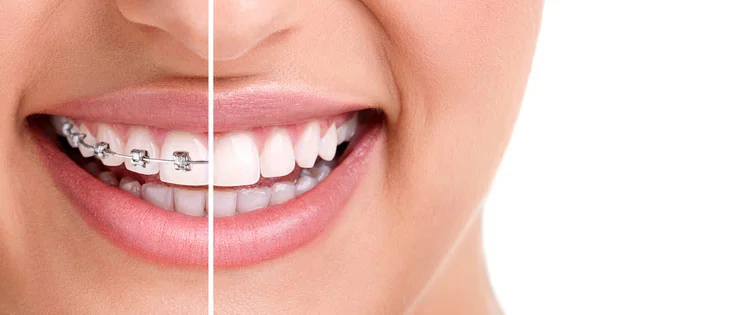 Touni Orthodontics Invisalign
