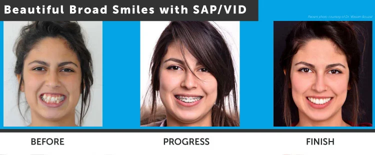 Touni Orthodontics Treatment Stages