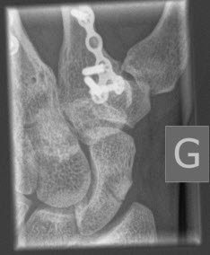 Left wrist x-ray showing a broken scaffoid and various metal parts from previously broken bones. 