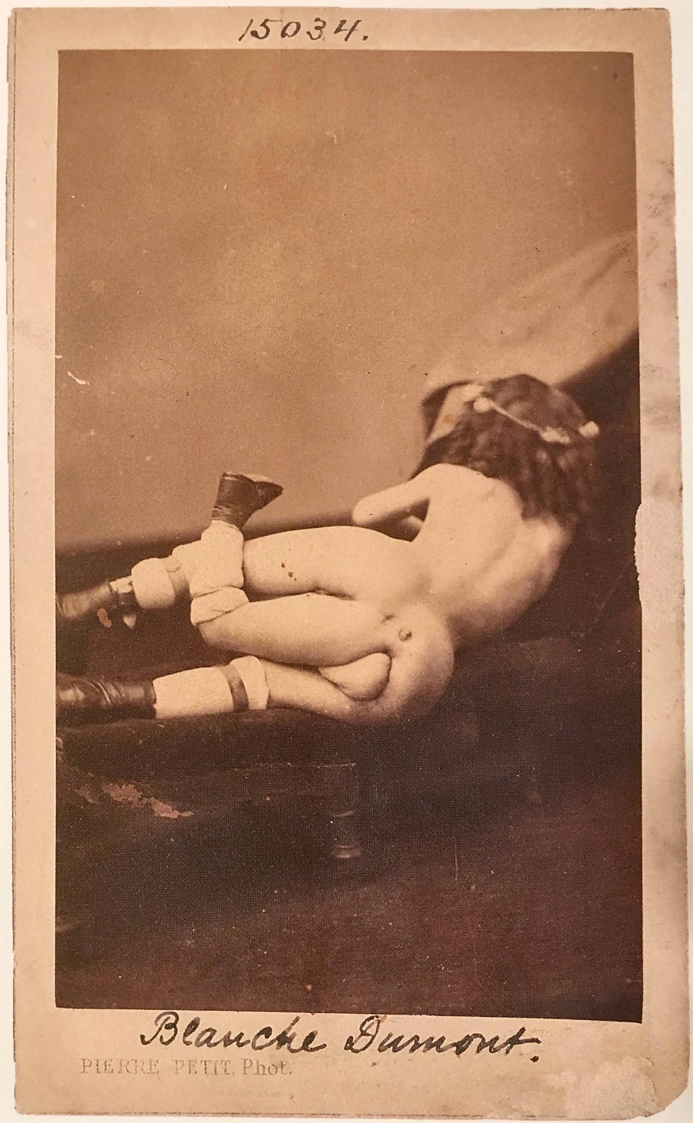 Blanche Dumas as photographed in Paris by Pierre Petit circa 1880 (page 101) Mütter Museum Historical Photographs.