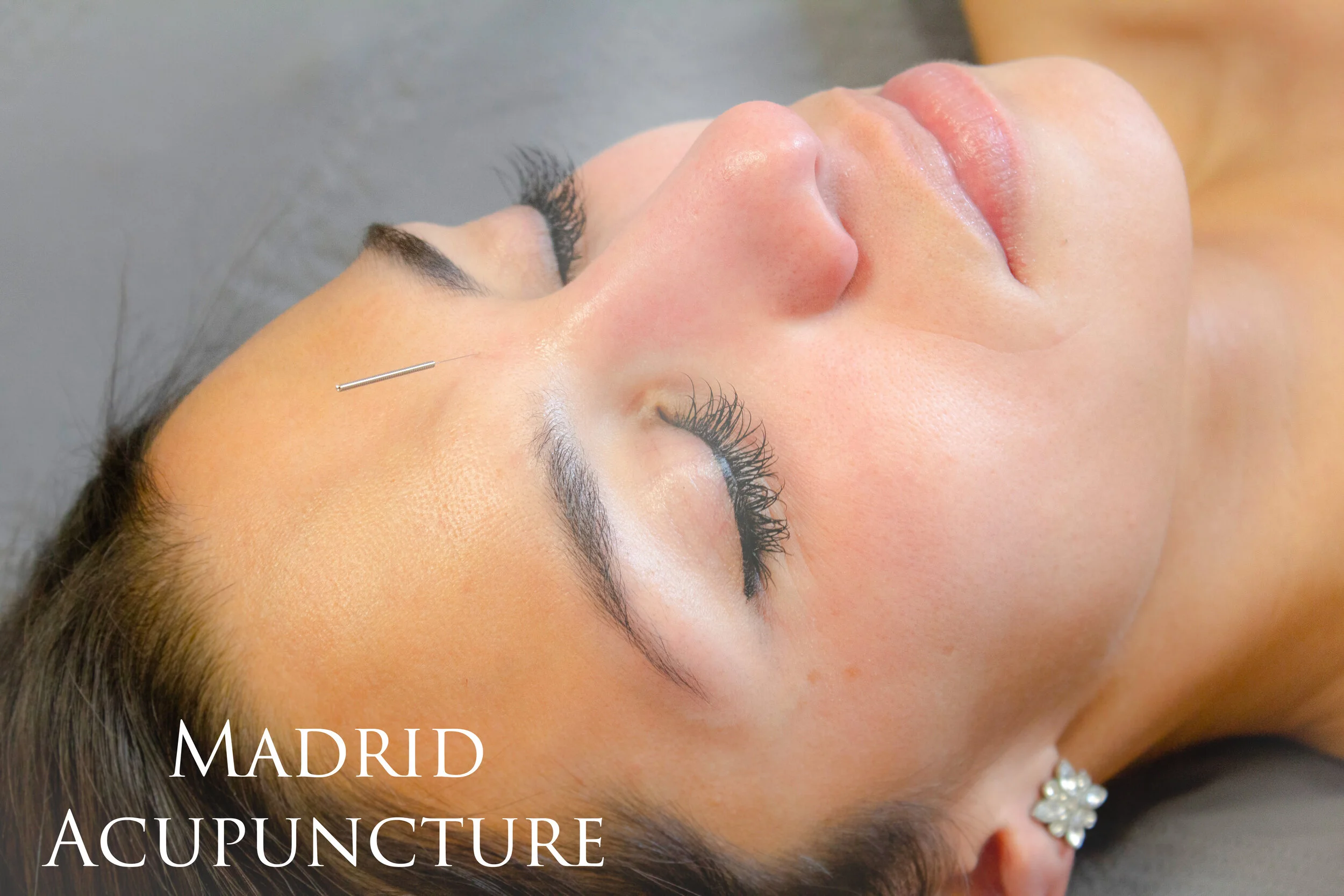 Feeling Stressed? Acupuncture can help!