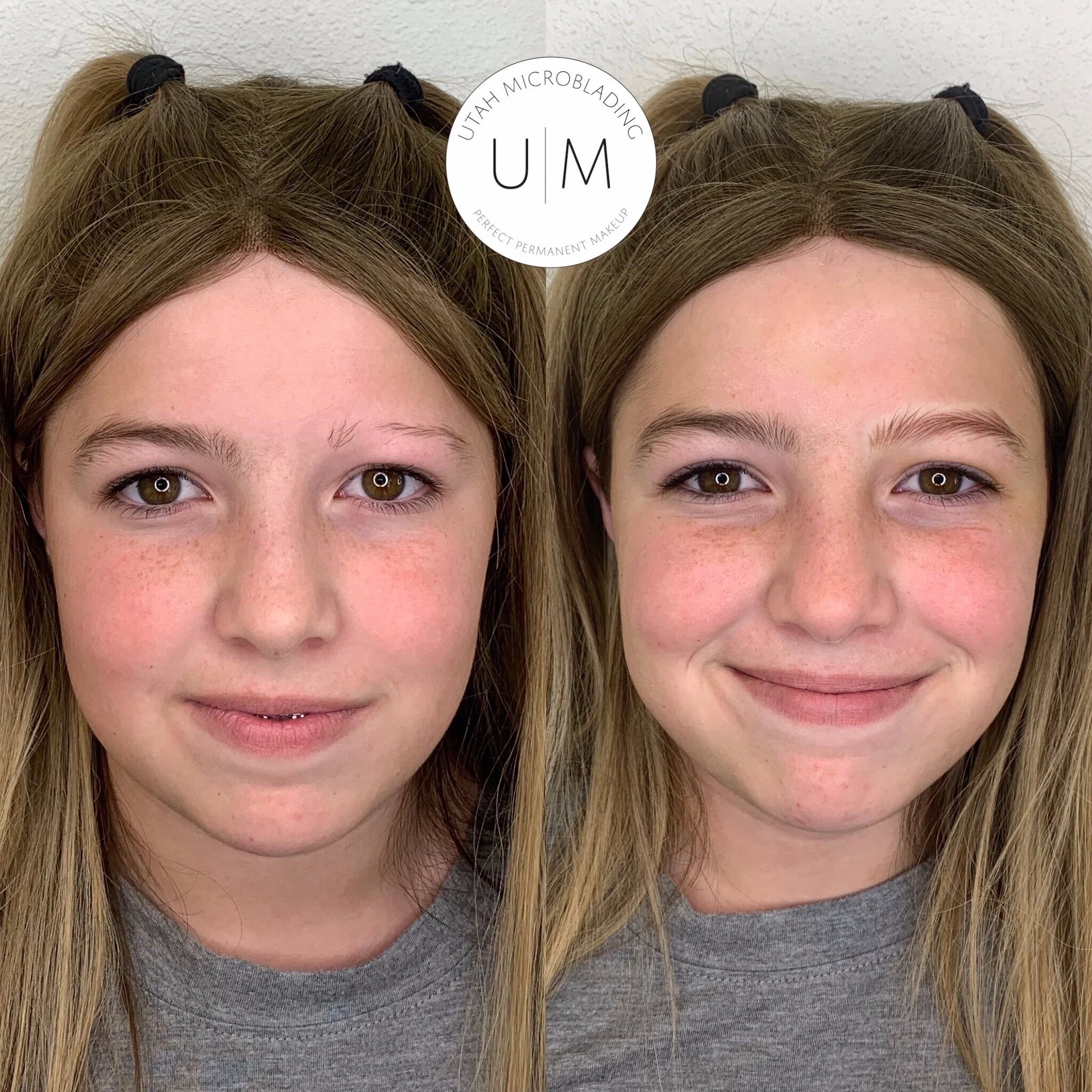 Alopecia Eyebrow Restoration 