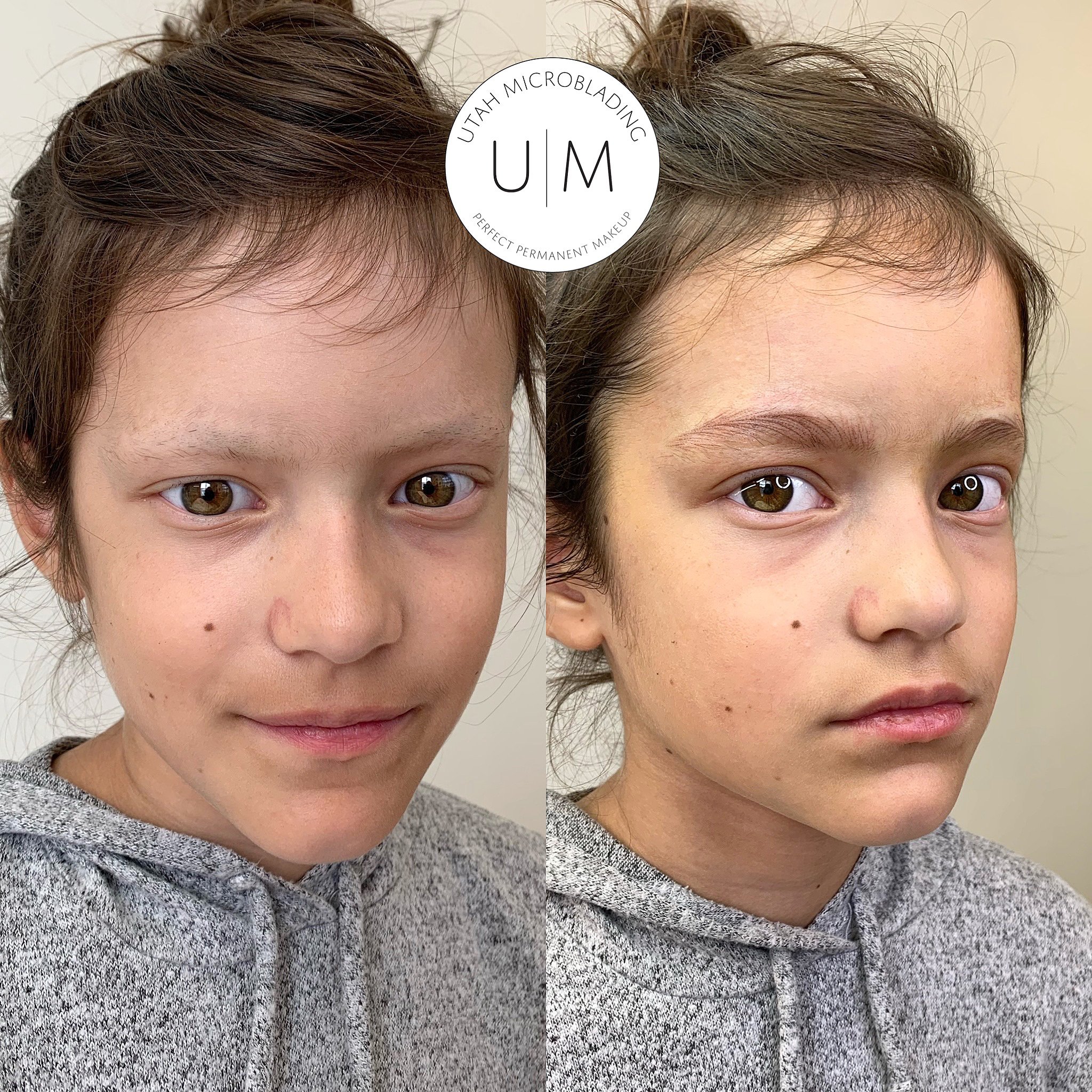 Eyebrow alopecia discount